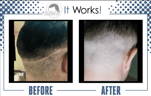 Scalp-Micropigmentation-For-Scars.png