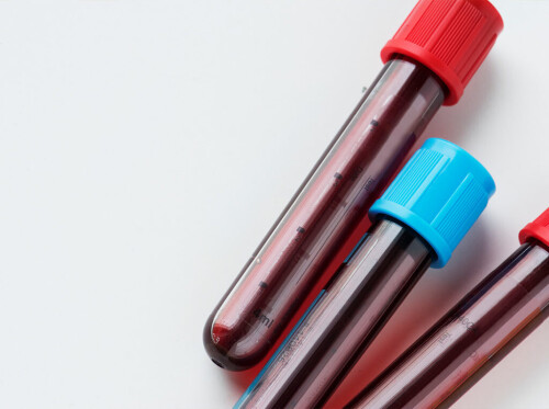 Descubra el costo total de un conteo sanguíneo completo, esta prueba evalúa su salud general y detecta una amplia gama de trastornos, como anemia, infecciones y leucemia. Visite nuestro sitio web hoy para más información



https://enterate.com/costo-de-un-hemograma-completo-en-miami.html