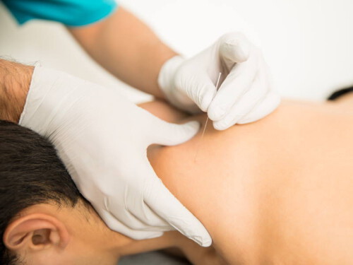 Dry-Needling02-800x600-1.jpg