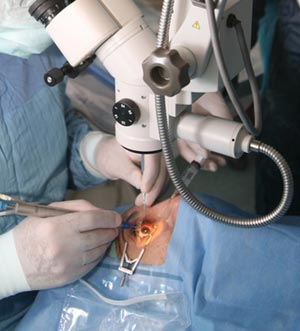 glaucoma-laser-surgery.jpg