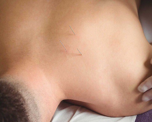 img-dry-needling-1-1024x682.jpg
