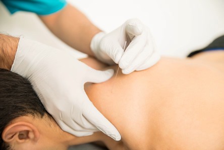 Dry-Needling.jpg