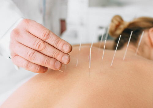 Dry-Needling.jpg