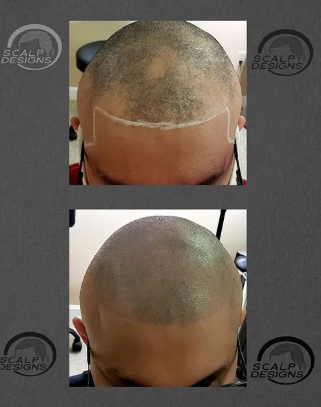 Scalp-Micropigmentation-For-Scars.png