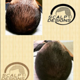 Scalp-Micropigmentation-For-Scars.png
