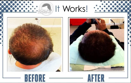 Scalp-Micropigmentation-Near-Me.png