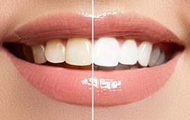 Teeth-Whitening-Treatment-Box.jpg