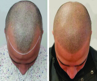 Scalp-Micropigmentation-Near-Me.jpg