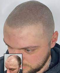 Scalp-Micropigmentation-For-Scars.jpg