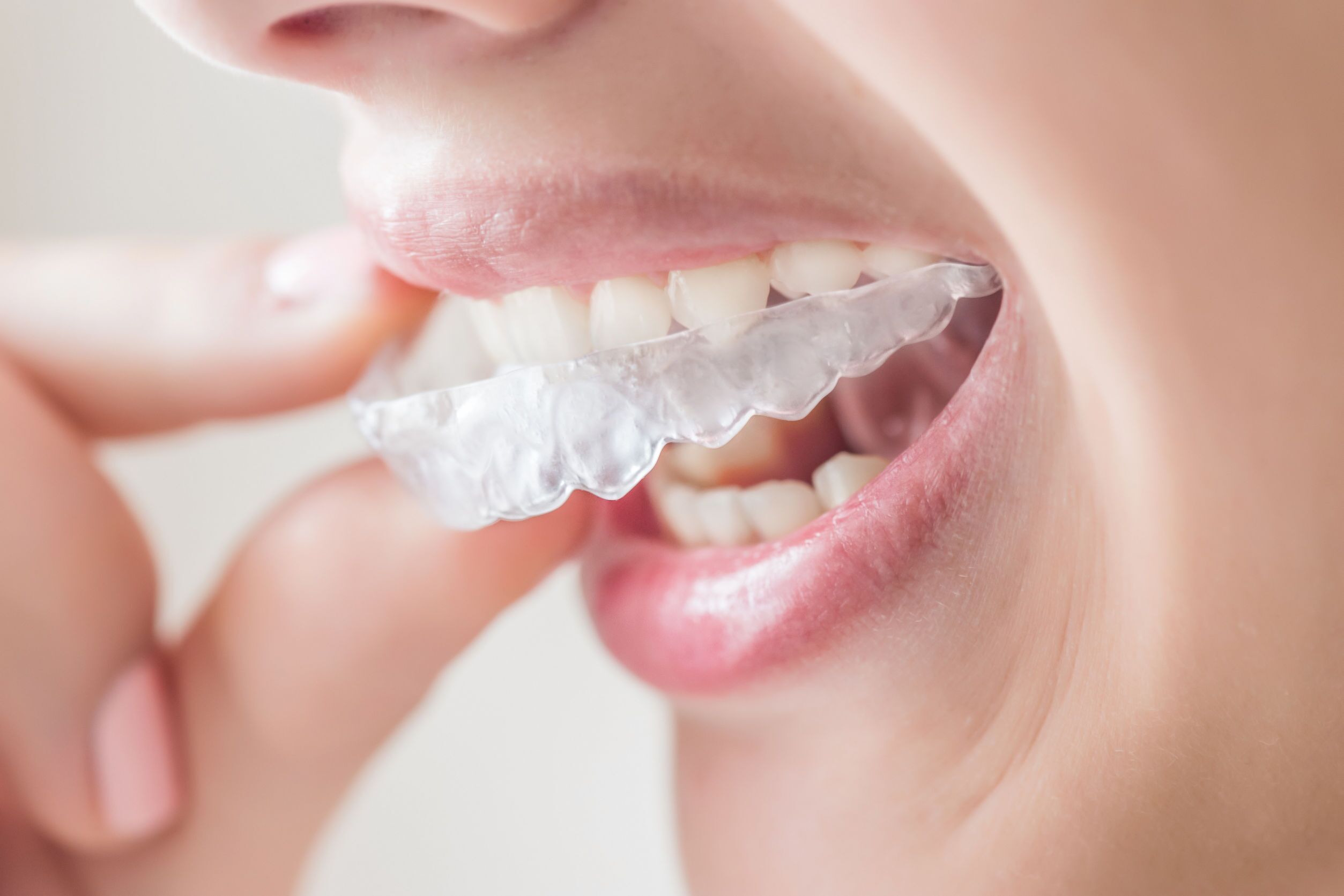 Invisalign. Каппы Инвизилайн. Инвизибл элайнеры. Элайнеры Invisalign. Элайнеры Инвизилайн.