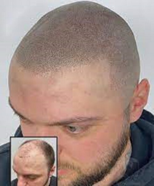 Scalp-Micropigmentation-For-Scars.jpg
