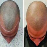 Scalp-Micropigmentation-Near-Me.jpg