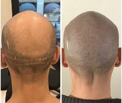 Scalp-Micropigmentation-For-Scars.jpg