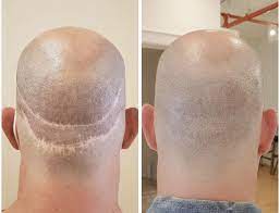 Scalp-Micropigmentation-Near-Me.jpg