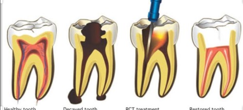 Mittal Dental Clinic Implant & Laser Centre in Nirman Nagar is one of the most preferred dental clinic in the Jaipur.

Read More; https://mittaldentalclinic.com/root-canals/