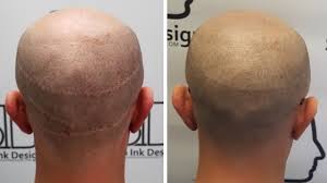 Scalp-Micropigmentation-For-Scars.jpg