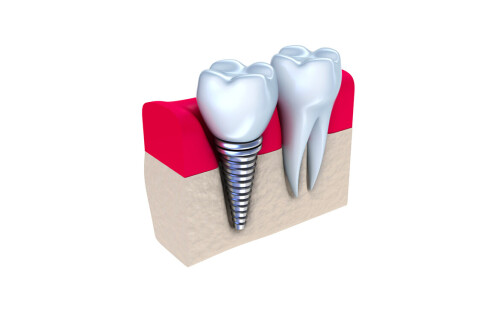Small-Dental-Implants-Image-3.jpg
