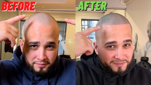 Scalp-Micropigmentation-in-Boston.jpg