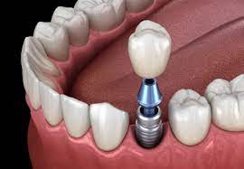 Find-Best-Denture-Clinics-in-Christchurch.jpg