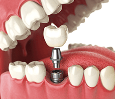 Find-Best-Denture-Clinics-in-Christchurch.png