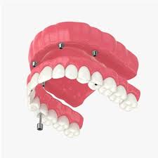 Permanent-Dentures-Cost-in-NZ..jpg