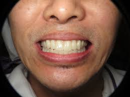 Permanent-Dentures-Cost-in-NZ.jpg