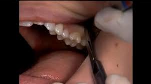 Molar-Removal-Course-Course-in-San-Francisco.jpg