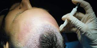 Best-Bosley-Hair-Transplant-Bost.jpg