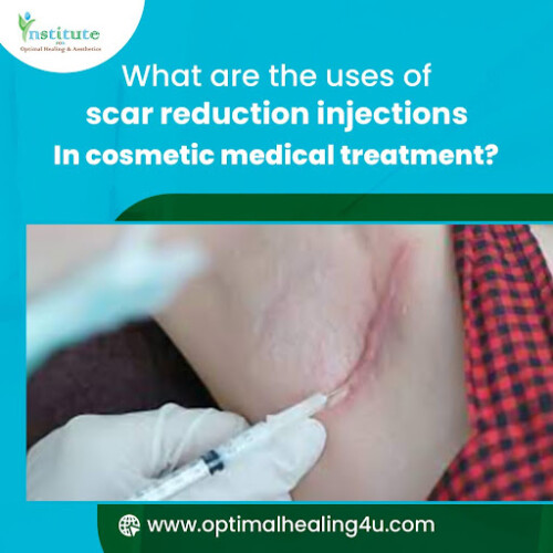 scar-reduction-injections-near-Florida.jpg
