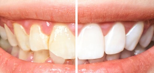 These therapies make use of cutting-edge methods and secure, reliable products. In-office whitening sessions are offered by several providers in Lakewood Ranch, enabling patients to arrive with stained or discolored teeth and leave with a notably brighter, whiter smile in a matter of hours. Convenience and flexibility are provided by at-home whitening kits with bespoke trays for people who prefer a more progressive approach.

https://www.paradisedentalsmiles.com/teeth-whitening/