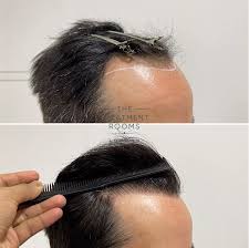 Hairline-Design-For-Scars.jpg