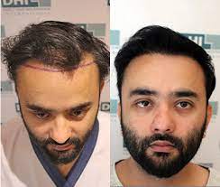 Hairline-Design-For-Scars.jpg