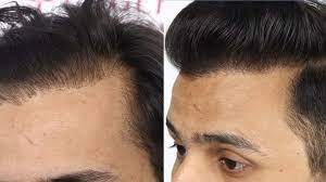 Hairline-Design-For-Scars.jpg