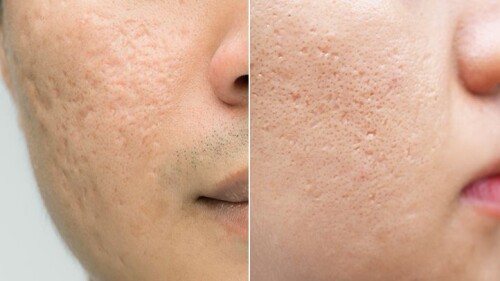 traetment-for-acne-scars.jpg