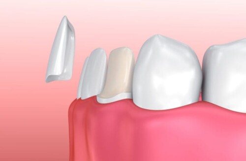 Numerous dentists and dental clinics in Bradenton, Florida provide tooth implant procedures. A comprehensive evaluation, which may include X-rays, is usually required to establish candidacy. Following the creation of a personalized treatment plan, the implant is surgically inserted and then allowed to heal until it merges with the bone (a process known as osseointegration). Lastly, the implant is fitted with a prosthetic tooth that looks natural.

https://www.paradisedentalsmiles.com/dental-implants/