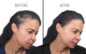 Scalp-Micropigmentation-For-Women.jpg