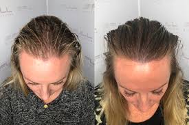 Scalp-Micropigmentation-For-Women.jpg