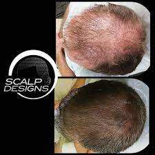 Best-Scalp-Micropigmentation-For-Long-Hair.jpg