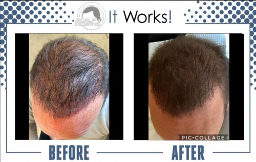 The exposure of the scalp may not be as noticeable in Scalp Micropigmentation For Long Hair people as it is in shorter hair or in people with shaved heads. Even so, some people may continue to have spotty or thinning regions, which are more obvious when hair is pushed back or styled a certain way. SMP can be used to make the hair appear fuller and thicker by reducing the contrast between the scalp and hair. For long-haired ladies experiencing diffuse thinning or isolated patches of hair loss, this can be especially helpful.

https://scalpdesigns.com/smp-for-long-hair/