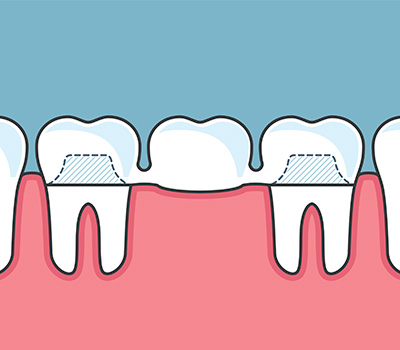 The-Best-Way-to-Get-Dental-Crowns-in-Kennesaw-GA.jpg