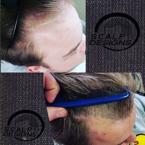The exposure of the scalp may not be as noticeable in Scalp Micropigmentation For Long Hair people as it is in shorter hair or in people with shaved heads. Even so, some people may continue to have spotty or thinning regions, which are more obvious when hair is pushed back or styled a certain way. SMP can be used to make the hair appear fuller and thicker by reducing the contrast between the scalp and hair. For long-haired ladies experiencing diffuse thinning or isolated patches of hair loss, this can be especially helpful.

https://scalpdesigns.com/smp-for-long-hair/
