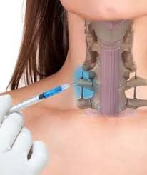 Best-Stellate-Ganglion-Block-For-Ptsd.jpg