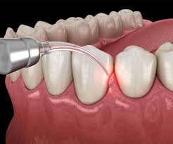 Gum-Disease-Treatment-in-Greenbrier-TN.jpg