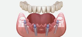 Revolutionize-Your-Smile-with-All-On-4-Dental-Implants-in-Anaheim-Hills-CA.jpg