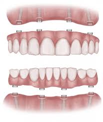 Revolutionize-Your-Smile-with-All-On-4-Dental-Implants-in-Anaheim-Hills-CA.jpg