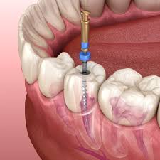 Best-Root-Canal-Treatment-In-Naperville.jpg