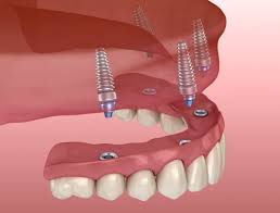 Revolutionize-Your-Smile-with-All-On-4-Dental-Implants-in-Anaheim-Hills-CA.jpg