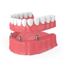 Revolutionize-Your-Smile-with-All-On-4-Dental-Implants-in-Anaheim-Hills-CA.jpg