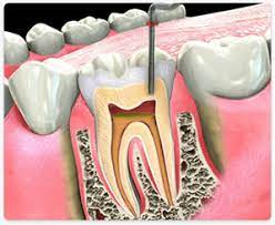 Best-Root-Canal-Treatment-In-Naperville.jpg