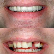 Missing-Teeth-Solutions-in-Morton-Grove-IL.jpg